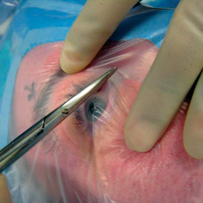 Formowalne okulistyczne jednorazowe sterylne serwety chirurgiczne z uchwytem na kabel